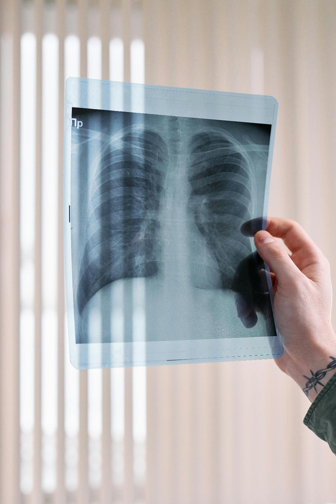 Innovadora molécula de Boehringer Ingelheim frena deterioro en Fibrosis Pulmonar